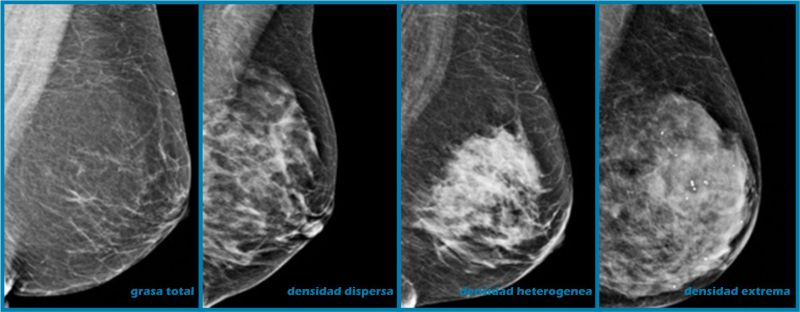 comparacion de mamas densas y fibrosas